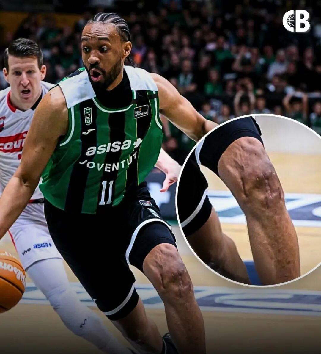 开云网址-好可怕的膝盖！两次ACL撕裂，他还在打球！！！